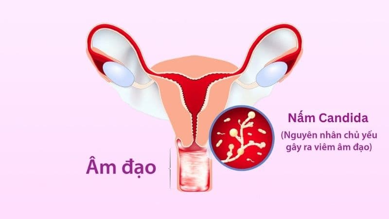 Nấm Candida thường tồn tại ở trạng thái cân bằng trong cơ thể, nhưng có thể phát triển quá mức và gây viêm nhiễm khi môi trường vùng kín bị mất cân bằng. 