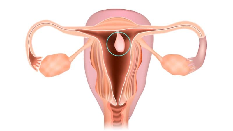 Sau cắt xoắn polyp cổ tử cung, người bệnh thường có thể sinh hoạt nhẹ và nên nghỉ ngơi khoảng 1–2 ngày. 