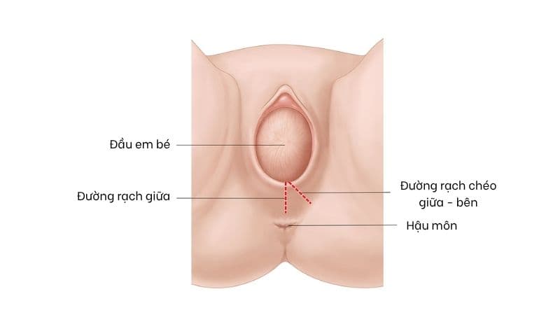 Rạch tầng sinh môn trong giai đoạn rặn sinh để hỗ trợ em bé ra ngoài thuận lợi hơn.
