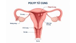 Cắt polyp cổ tử cung bao lâu thì lành và cách chăm sóc nhanh khỏi