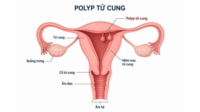Cắt polyp cổ tử cung bao lâu thì lành và cách chăm sóc nhanh khỏi