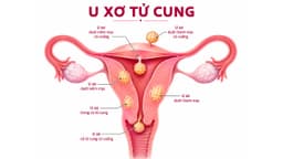 Cẩm nang toàn diện về u xơ tử cung: Nhận biết, rủi ro và các phương pháp xử lý