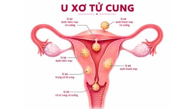 Cẩm nang toàn diện về u xơ tử cung: Nhận biết, rủi ro và các phương pháp xử lý