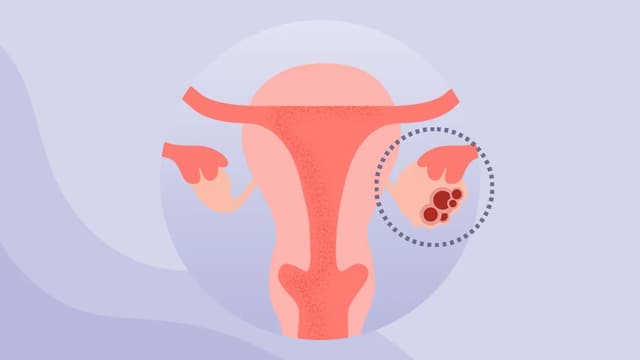 U nang buồng trứng: Nguyên nhân, dấu hiệu, mức độ nguy hiểm và cách điều trị