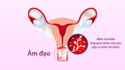 Nấm Candida: Vì sao mắc bệnh và cách điều trị như thế nào?