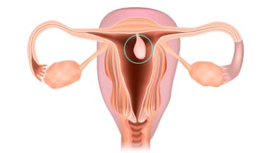 Cắt polyp tử cung cần nghỉ ngơi bao lâu để hồi phục hoàn toàn?
