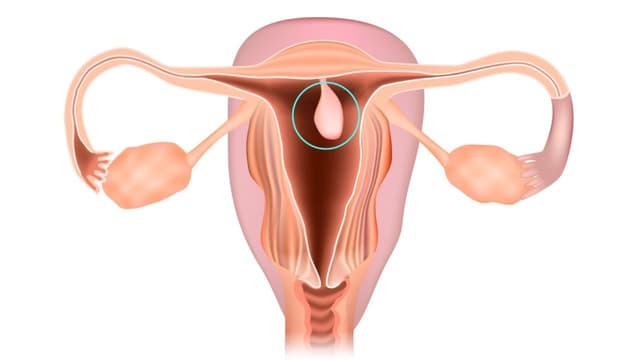 Cắt polyp tử cung cần nghỉ ngơi bao lâu để hồi phục hoàn toàn?