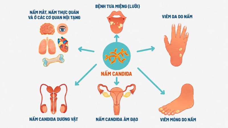 Nấm Candida phát triển quá mức có thể gây viêm âm đạo. 