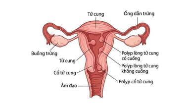 Cắt Polyp Cổ Tử Cung Giá Bao Nhiêu? Chi Phí Mới Nhất