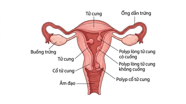Cắt Polyp Cổ Tử Cung Giá Bao Nhiêu? Chi Phí Mới Nhất