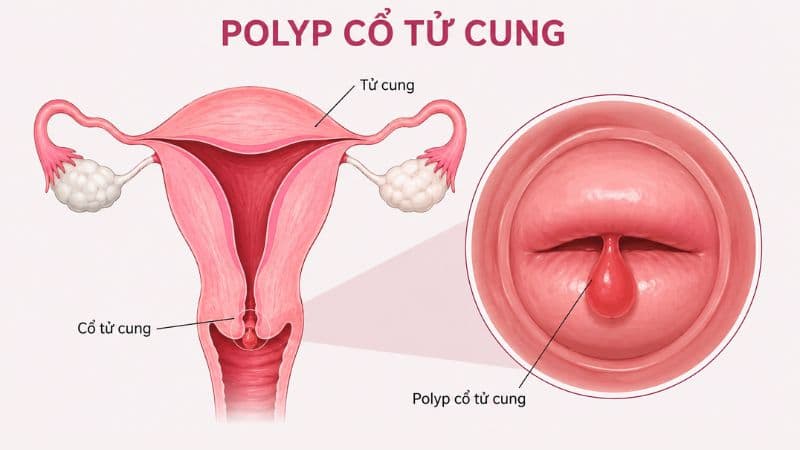 Polyp cổ tử cung có chân cuống nhỏ, rõ thường dễ xử trí hơn so với polyp lớn, chân rộng hoặc nằm sâu.