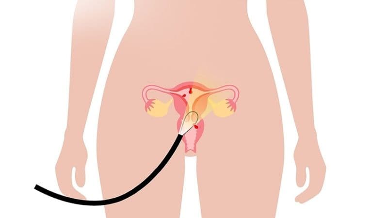 Kích thước, số lượng và vị trí bám của polyp có thể ảnh hưởng đến mức độ phức tạp và chi phí thực hiện thủ thuật.