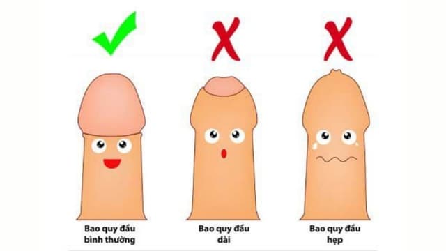 Cắt bao quy đầu gây mê: Quy trình, chi phí và lưu ý chăm sóc
