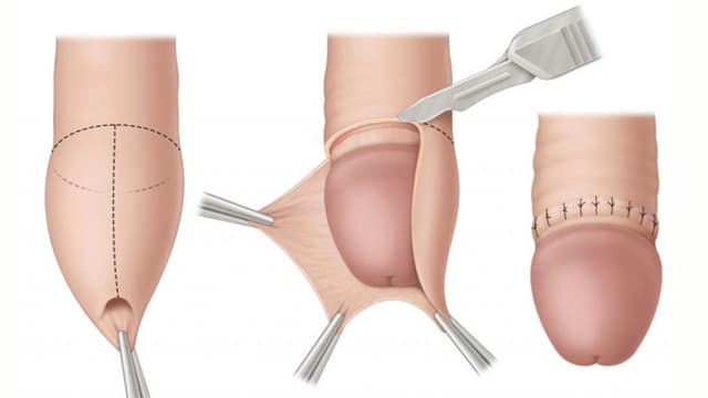 Cắt bao quy đầu gây tê có đau không? Quy trình và các bước chăm sóc