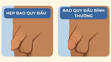 Cắt hẹp bao quy đầu: Khi nào cần điều trị và phẫu thuật?