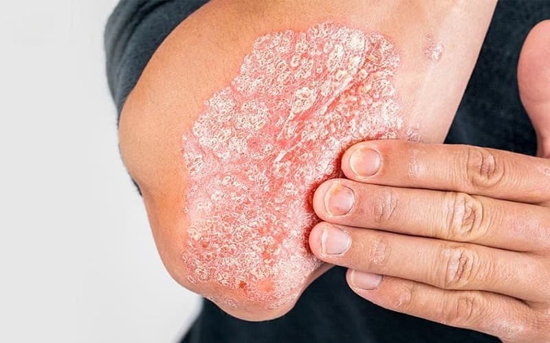 Bệnh da liễu ảnh hưởng đến chất lượng cuộc sống và gây mất thẩm mỹ