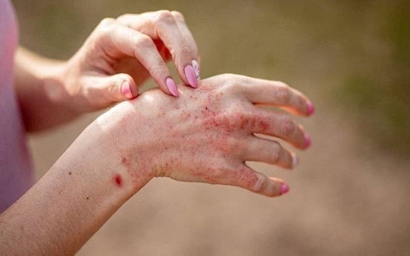 Có nhiều nguyên nhân gây bệnh da liễu