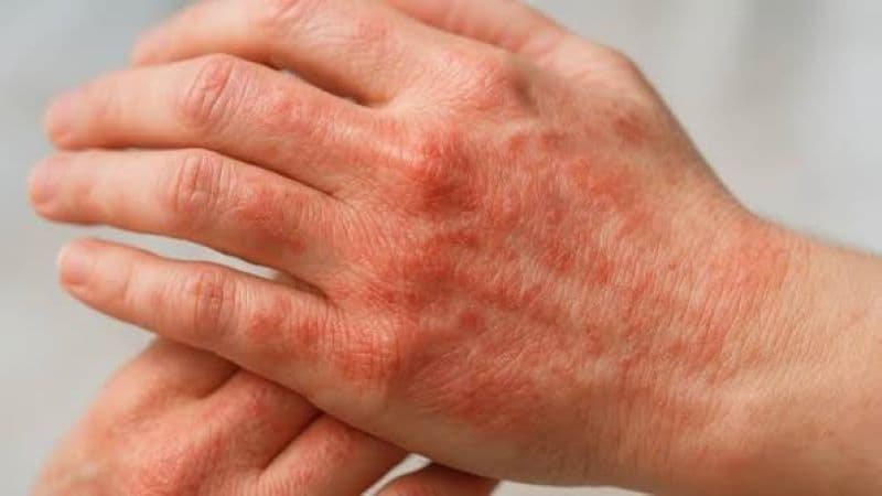 Bạn nên gặp bác sĩ Da liễu khi các triệu chứng trên da kéo dài, tái phát và lan rộng