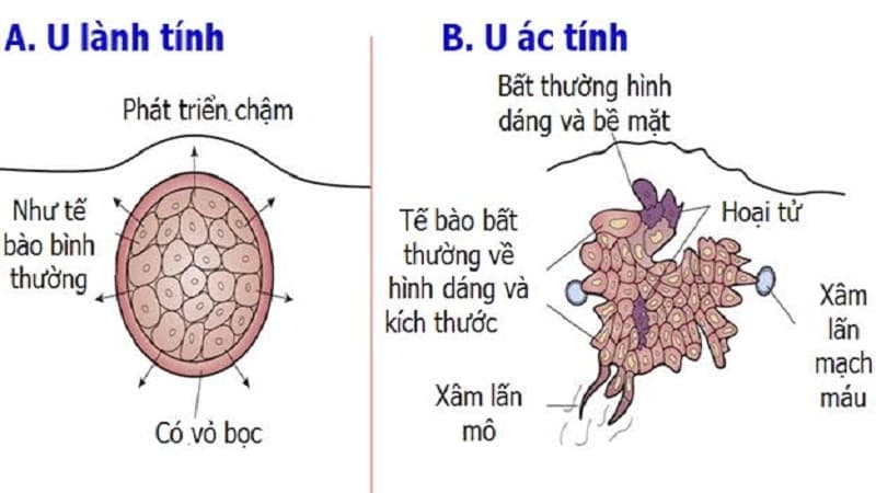 bác sĩ ung bướu giỏi ở Yên Hòa