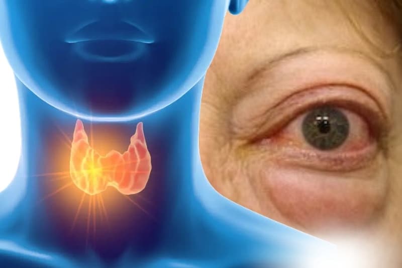 Bệnh basedow gây ra triệu chứng phì đại tuyến giáp và làm tổn thương các mô mềm xung quanh mắt