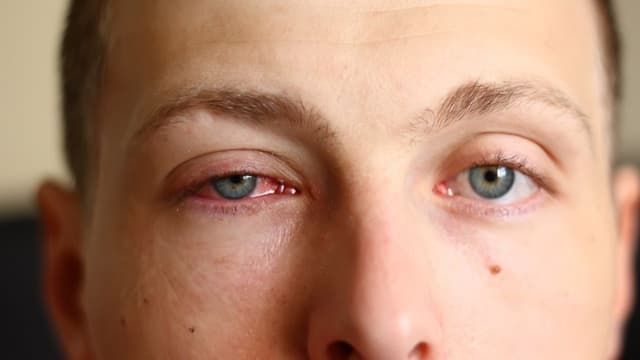 Bệnh nhậm mắt là gì? Nguyên nhân, triệu chứng và cách điều trị