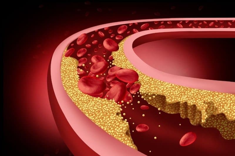 Sự hình thành mảng xơ vữa từ cholesterol và các chất lắng đọng trên thành mạch là nguyên nhân chính dẫn đến bệnh tim mạch do xơ vữa
