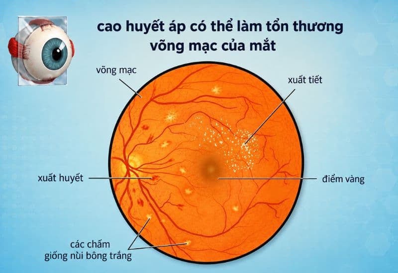 bệnh võng mạc cao huyết áp