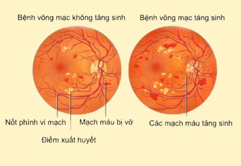 bệnh võng mạc đái tháo đường