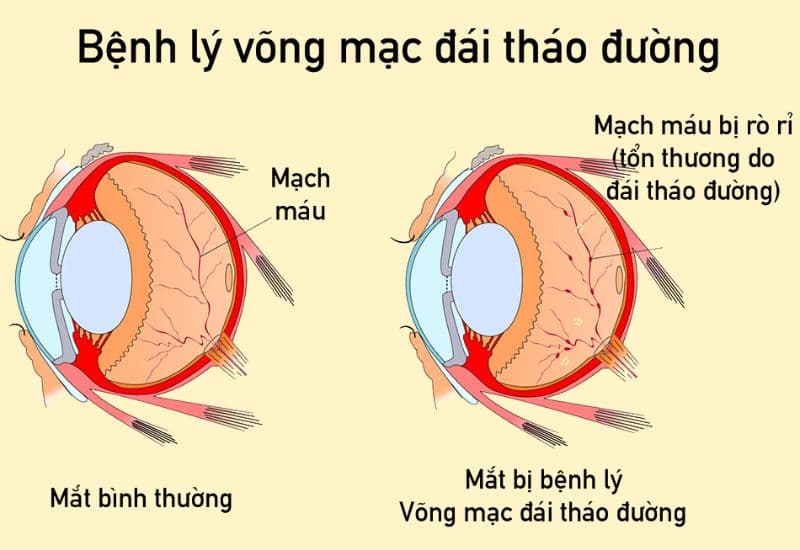 bệnh võng mạc đái tháo đường