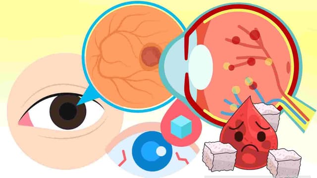 Bệnh võng mạc đái tháo đường: Hiểm họa thầm lặng và cách bảo vệ đôi mắt