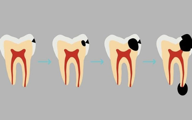 Các giai đoạn phát triển của sâu răng