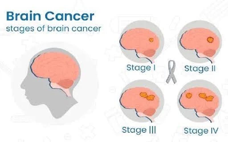 Các giai đoạn ung thư não