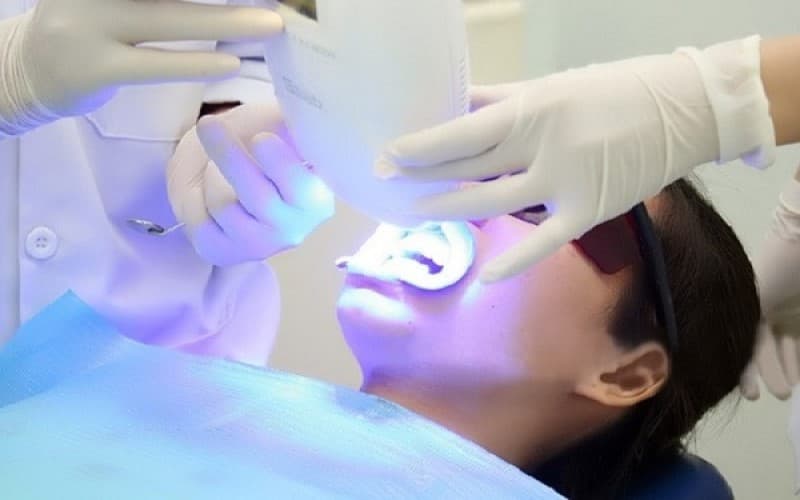 Các phương pháp tẩy trắng răng phổ biến