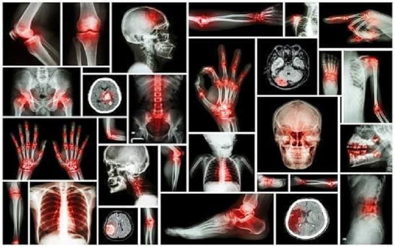 Các vị trí ung thư xương trên cơ thể