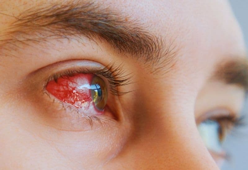 Hiện tượng của đau mắt đỏ nhận biết thế nào?