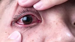Cách làm hết đau mắt đỏ an toàn và những điều cần lưu ý