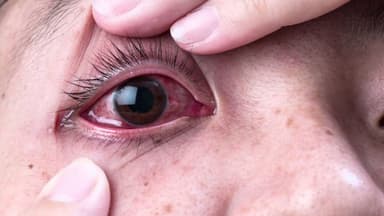 Cách làm hết đau mắt đỏ an toàn và những điều cần lưu ý