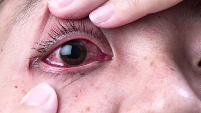 Cách làm hết đau mắt đỏ an toàn và những điều cần lưu ý