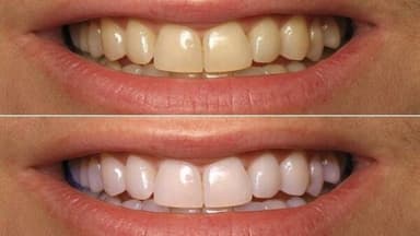 Bật mí 15+ cách làm trắng răng tại nhà hiệu quả, an toàn và tiết kiệm