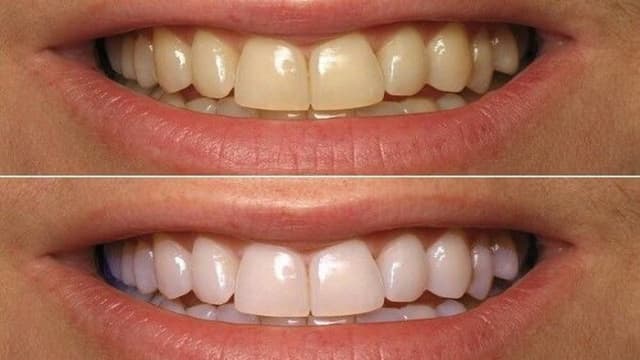 Bật mí 15+ cách làm trắng răng tại nhà hiệu quả, an toàn và tiết kiệm