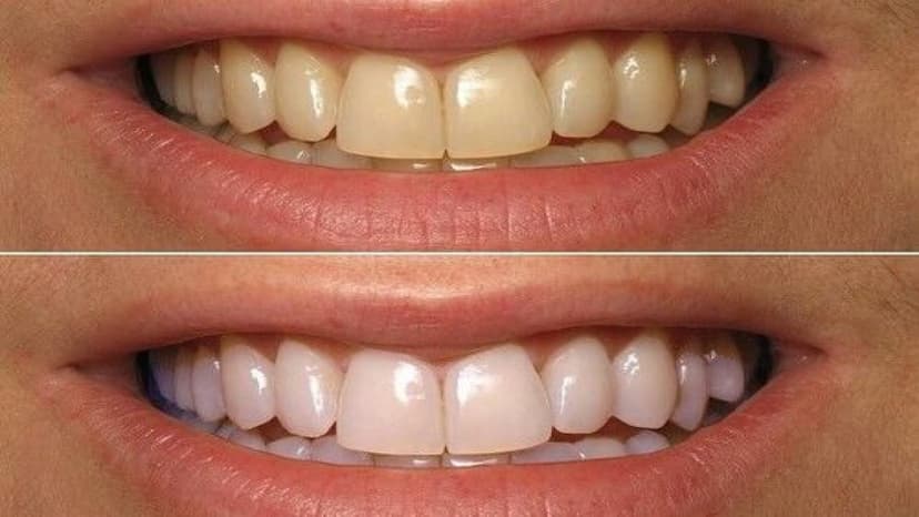 Bật mí 15+ cách làm trắng răng tại nhà hiệu quả, an toàn và tiết kiệm