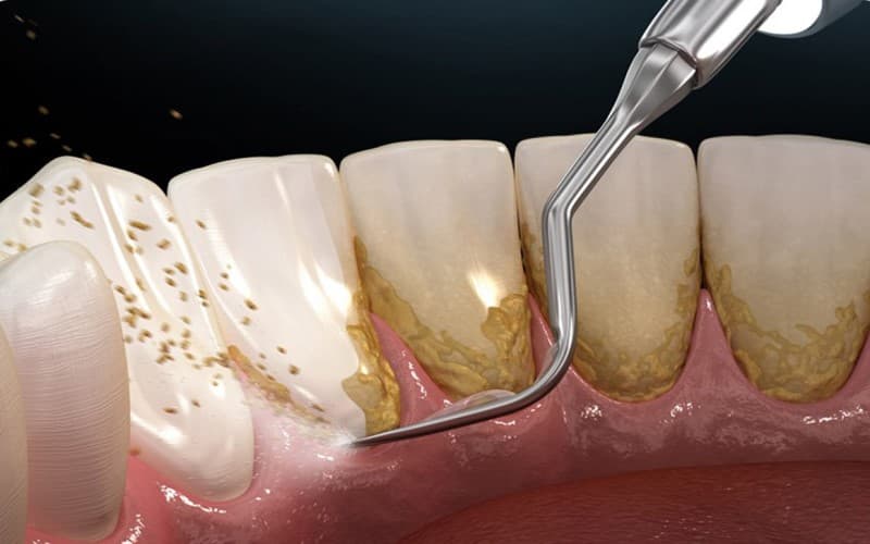 Cạo vôi răng định kỳ có quan trọng không?