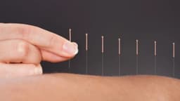 Châm cứu bấm huyệt: Phương pháp y học cổ truyền và ứng dụng hiện đại