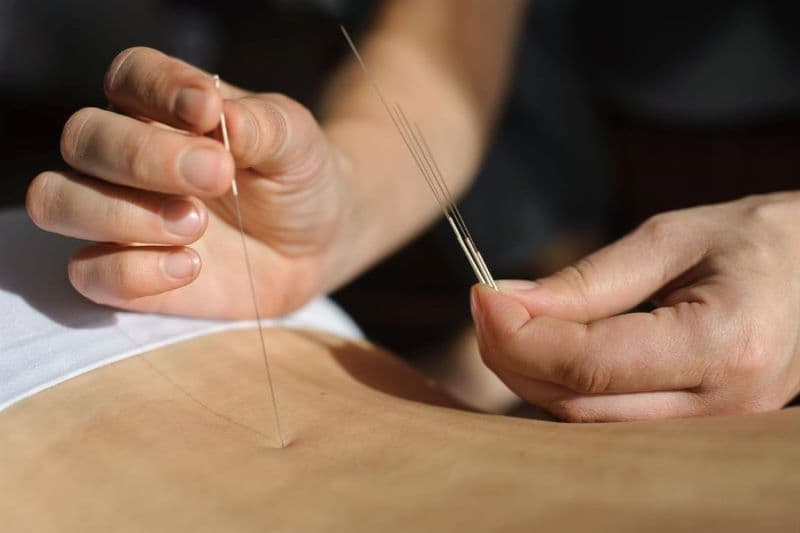 Cấy chỉ là kỹ thuật đưa một đoạn chỉ tự tiêu vào vị trí huyệt nhằm tạo kích thích kéo dài hơn so với một lần châm kim thông thường
