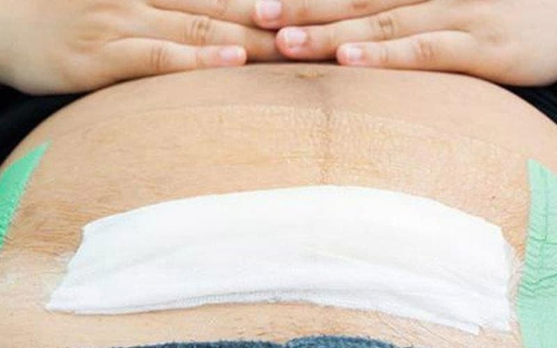 Chăm sóc vết mổ đúng cách để tránh nhiễm trùng