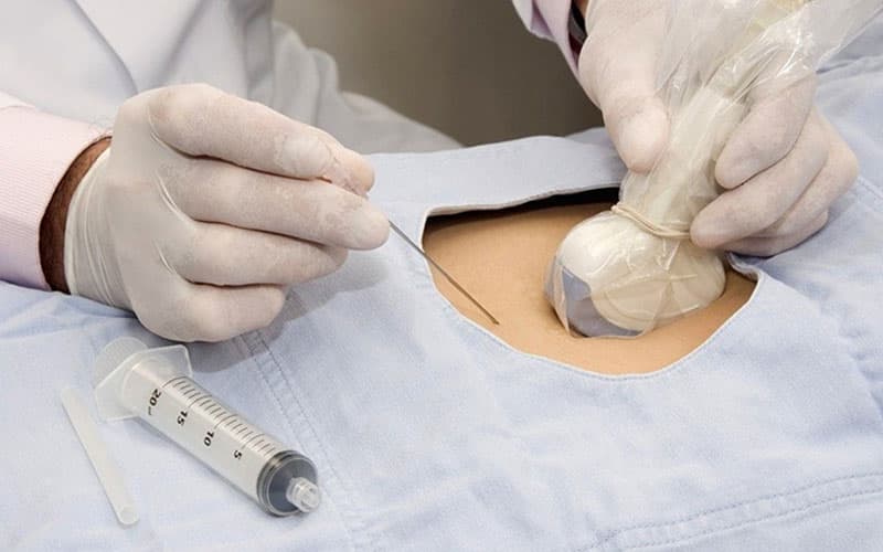 Chọc ối giúp xét nghiệm chính xác bất thường NST của thai