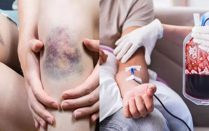 Thâm tím bất thường có thể là dấu hiệu của bệnh lý ung thư máu