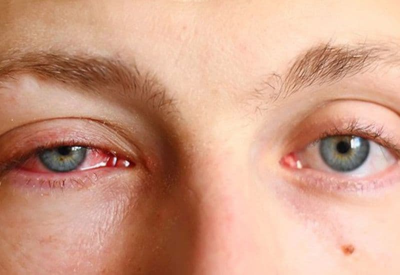 đau mắt đỏ chảy nước mắt