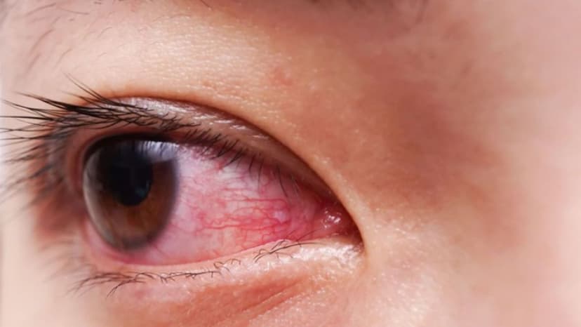 Đau mắt đỏ chảy nước mắt: Nguyên nhân và cách xử lý