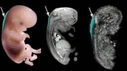 Độ mờ da gáy và Double Test: Thời điểm, chỉ số và ý nghĩa sàng lọc